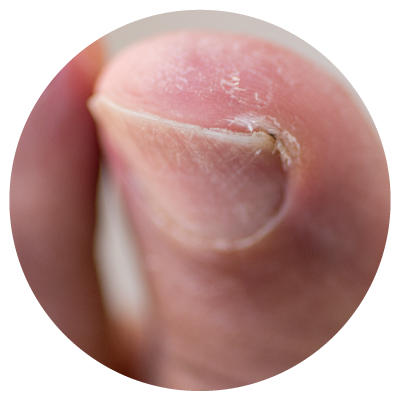 big toe with ingrown toenail