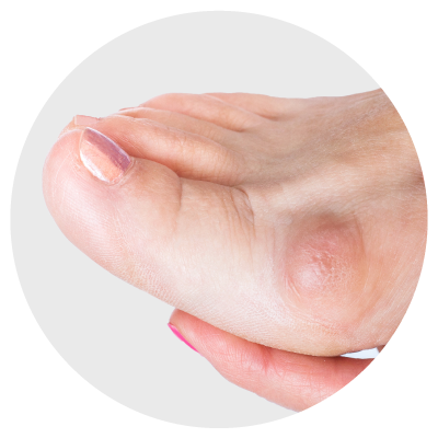 foot with bunion