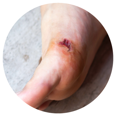 foot with large diabetic sore
